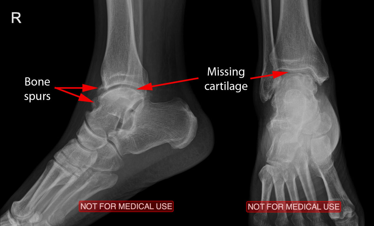 ankle x-rays
